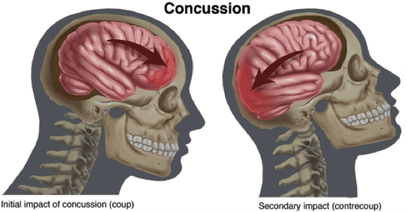 Blood Markers Could Accurately Detect Concussion Blood Markers Could Accurately Detect Concussion