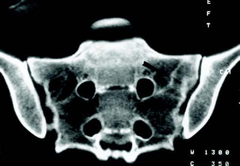CT Scan of Stress Fracture - El Paso Chiropractor