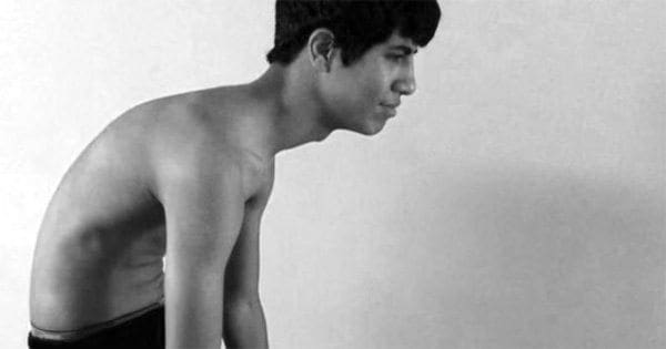 Extranjero sucesor perfil La quiropráctica corrige la espalda encorvada para adolescentes - El Paso  Back Clinic® • 915-850-0900
