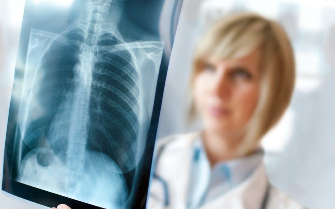 Sports Injuries: Stress Fractures to the Ribs