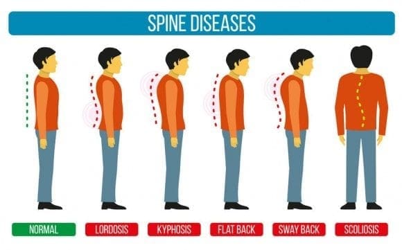 curve_disorders56432443_M-1.jpg