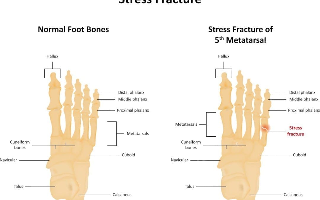 What A Stress Fracture Really Feels Like, & How to Keep It From Happening To You
