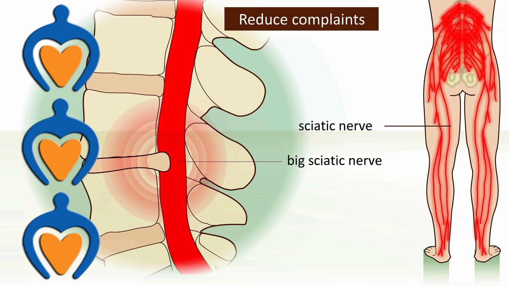 Scientific Chiropractor Herniated Disc Signs And Symptoms El Paso