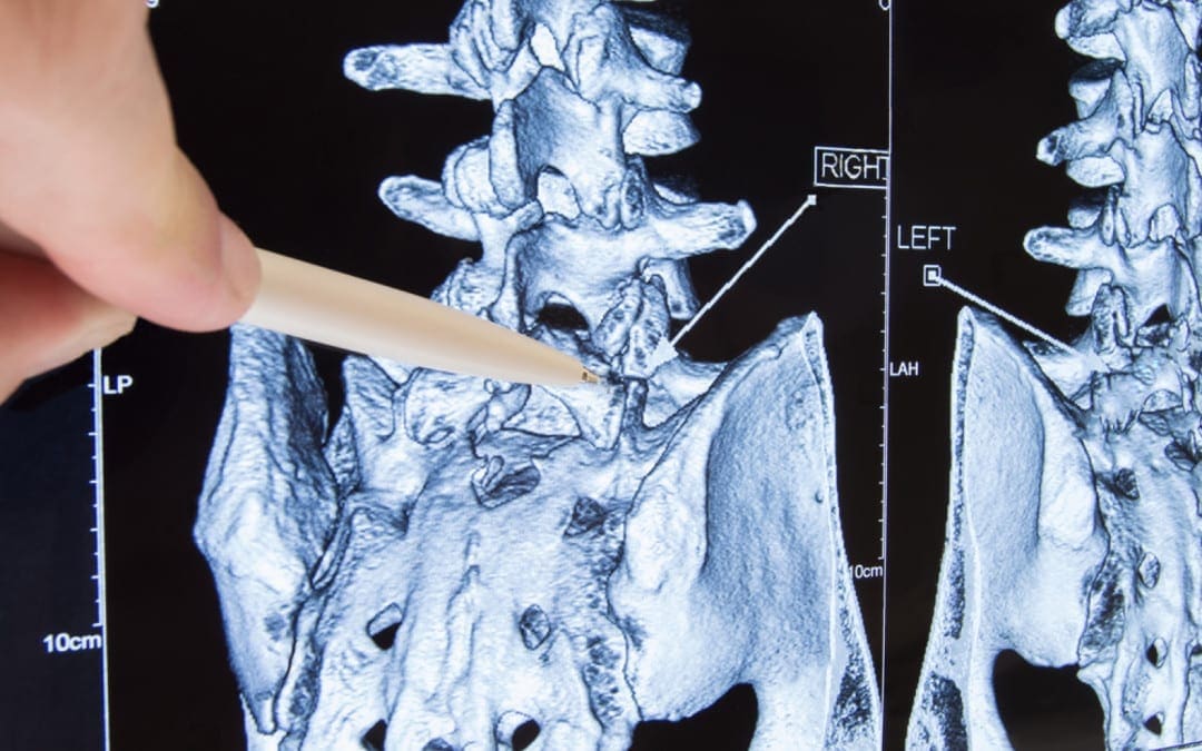Extension-Related Low Back Pain: Sports & Science