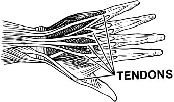 tendinosis