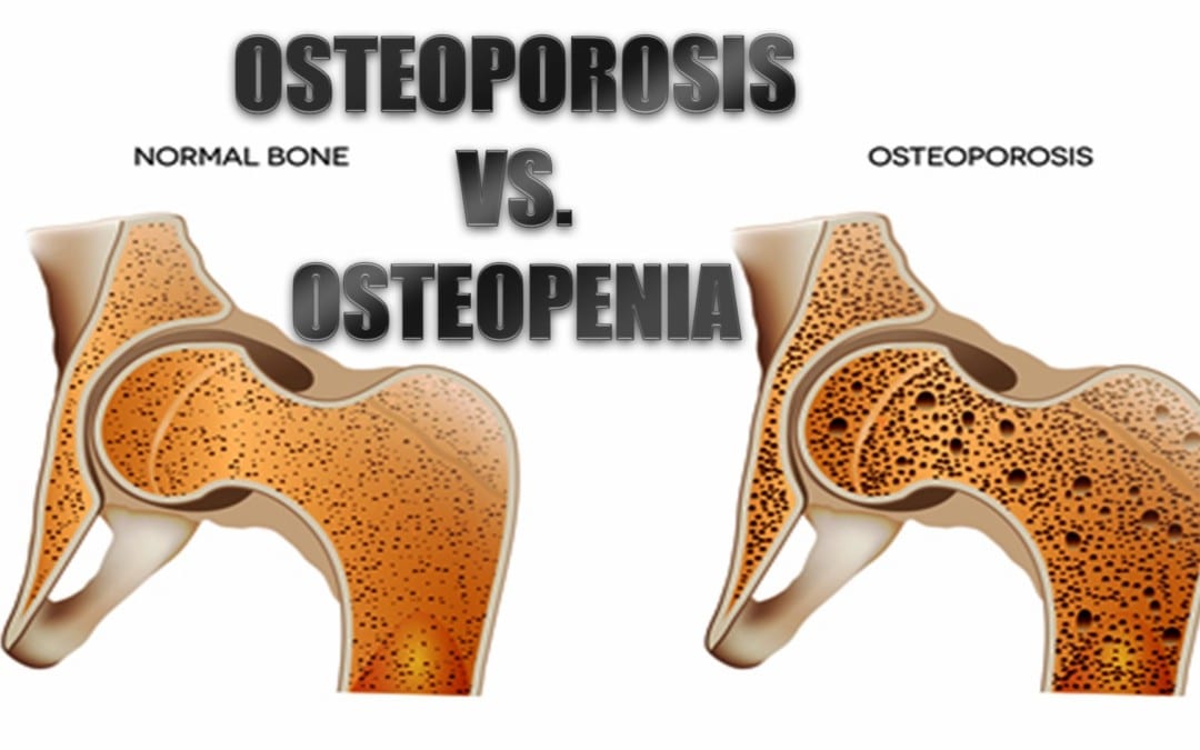 Osteoporosis vs. Osteopenia: What’s The Difference?