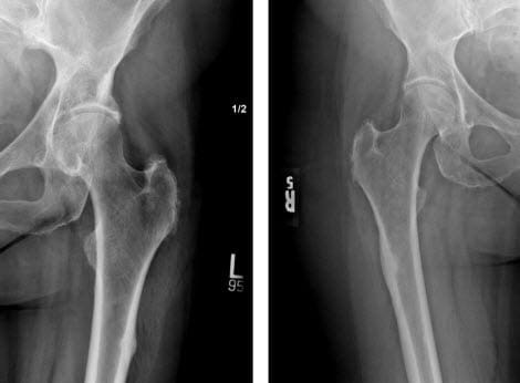 Bisphosphonate-Related Proximal Femoral Fractures