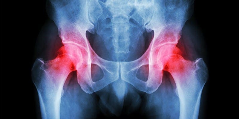 Evaluation of the Patient with Hip Pain