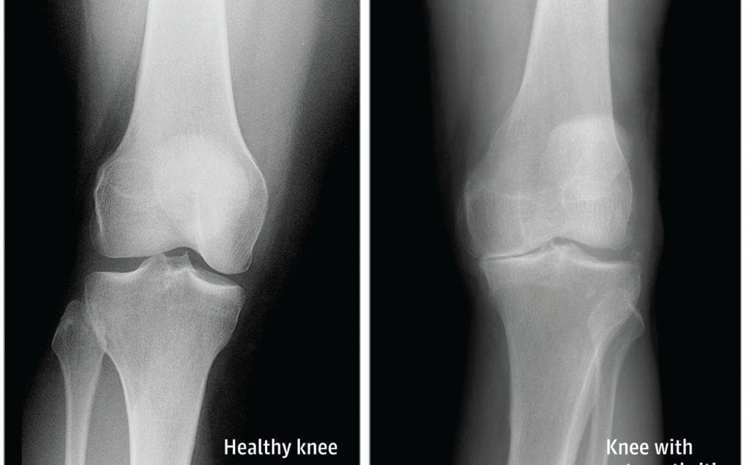 How Arthritis Can Affect the Knee | El Paso, TX Chiropractor