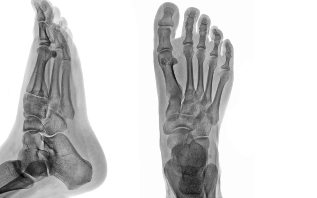 Ankle & Foot Diagnostic Imaging Arthritis & Trauma I | El Paso, TX.