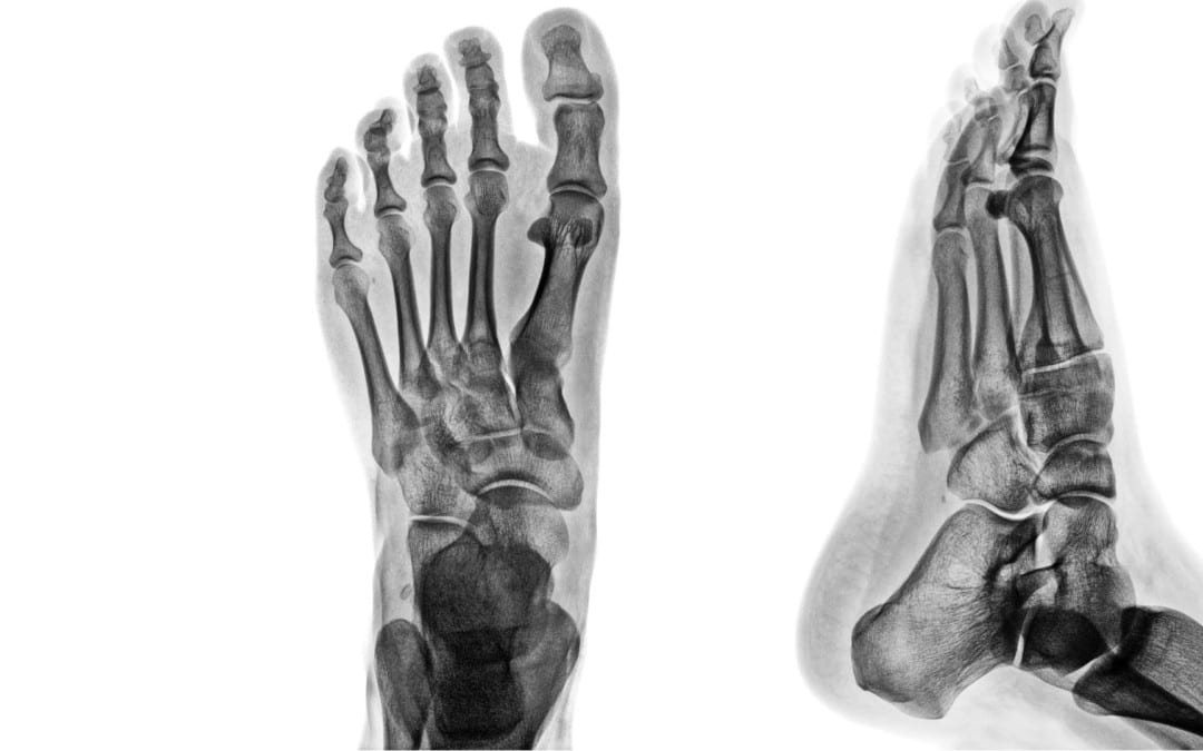 Ankle & Foot Diagnostic Imaging Arthritis & Trauma II| El Paso, TX.