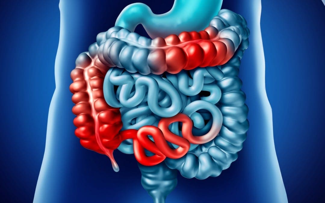 What is Crohn’s Disease? An Overview