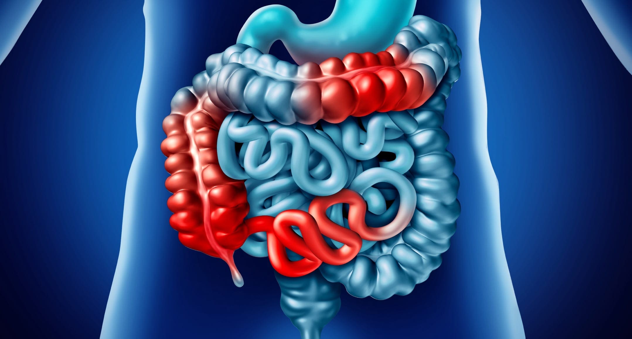 What is Crohn's Disease? An Overview - El Paso Back Clinic® • 915-850-0900