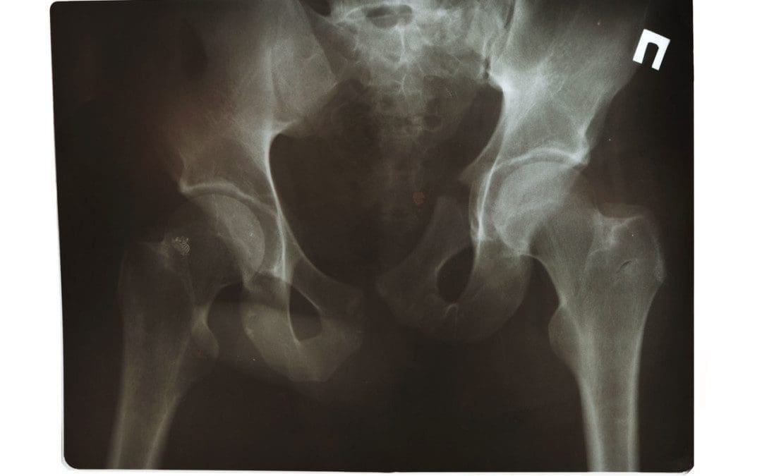 Sacral Fracture