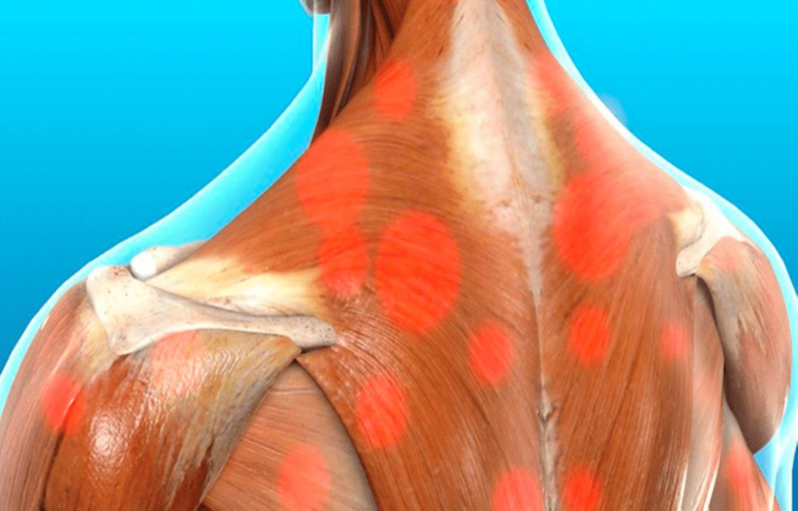 myofascial-trigger-pain-affecting-the-trapezius-muscle-el-paso-back