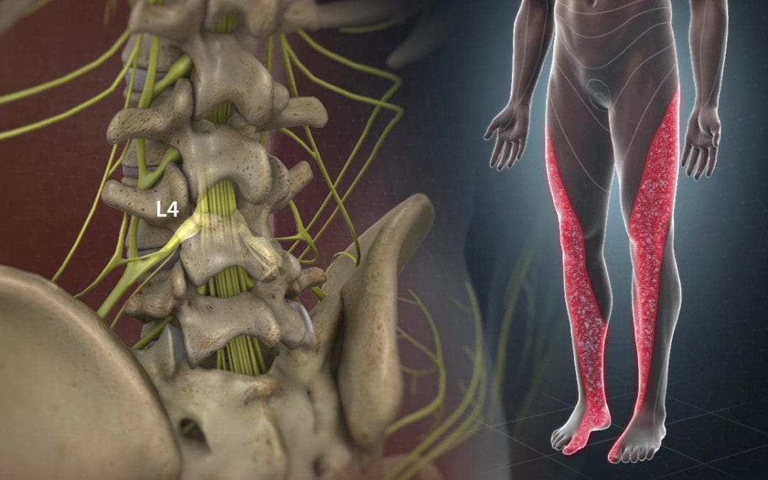 Incorporating Spinal Decompression Treatments For Lumbosacral Pain