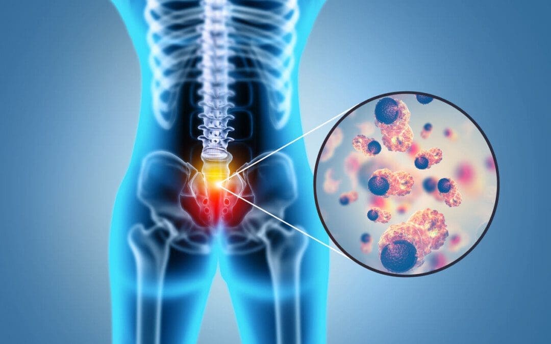 Pathology of Lumbar Disc Degeneration: Expert Guide