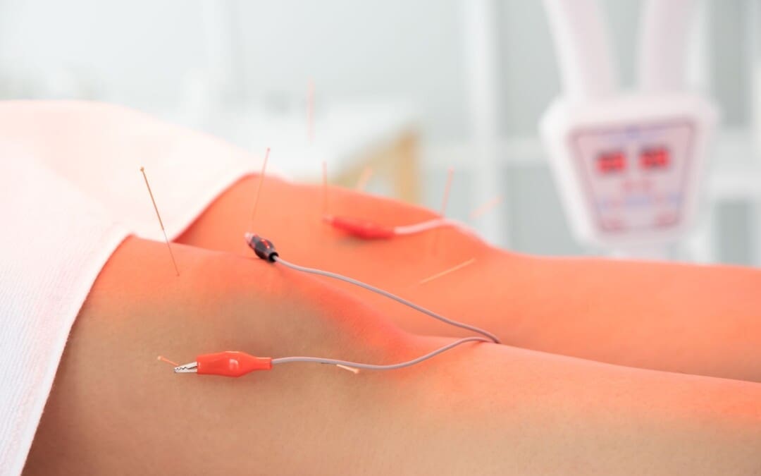 How Acupuncture-Electroacupuncture Can Improve Your Health