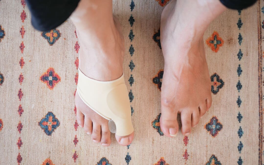 Bunions: Causes, Symptoms, and Treatments Explored