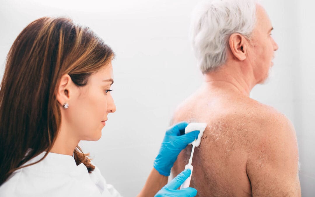 Excision of a Dysplastic Nevus: Step-by-Step Approach