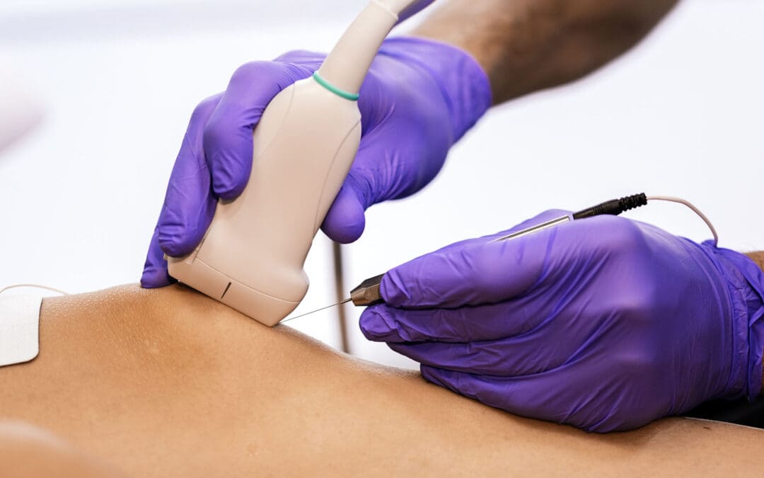 Tendon Healing with Percutaneous Tenotomy Overview